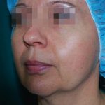 Facetite and Bodytite Before & After Patient #7249