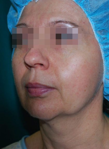 Facetite and Bodytite Before & After Patient #7249