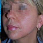 Facetite and Bodytite Before & After Patient #7249