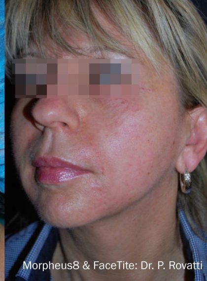 Facetite and Bodytite Before & After Patient #7249