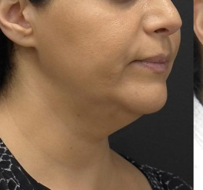 Facetite and Bodytite Before & After Patient #7253