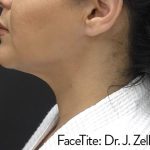 Facetite and Bodytite Before & After Patient #7253