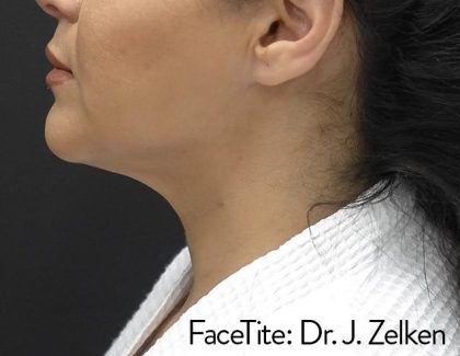 Facetite and Bodytite Before & After Patient #7253