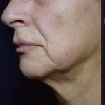 Facetite and Bodytite Before & After Patient #7254