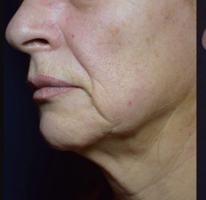 Facetite and Bodytite Before & After Patient #7254