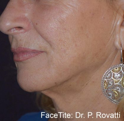 Facetite and Bodytite Before & After Patient #7254