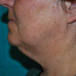 Facetite and Bodytite Before & After Patient #7255