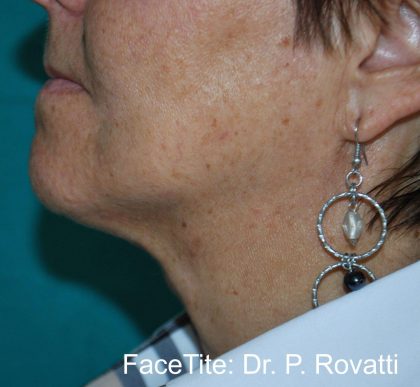 Facetite and Bodytite Before & After Patient #7255