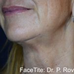 Facetite and Bodytite Before & After Patient #7256