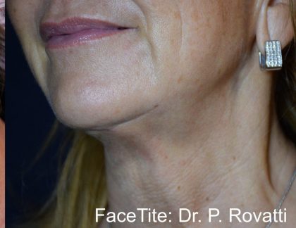 Facetite and Bodytite Before & After Patient #7256