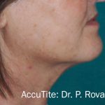 Facetite and Bodytite Before & After Patient #7259