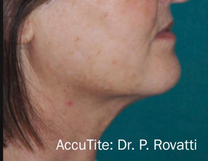 Facetite and Bodytite Before & After Patient #7259